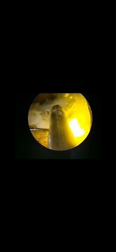 Removing UroLift implant using Green Light Laser. Courtesy Feras Al Jaafari