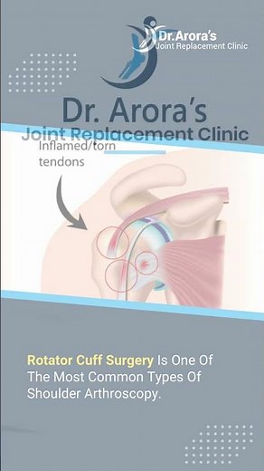 Rotator Cuff Surgery: What You Need To Know About Shoulder Arthroscopy