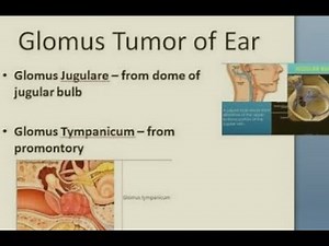 Middle ear tumor (Glomus)