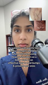 Hidradenitis suppurativa (HS) is characterized by chronic, painful boils or lumps in hair-bearing locations (like the armpits and groin). This condition can flare due to bacterial colonization. Pyrithione zinc, which is the active ingredient in Head & Shoulders, is antimicrobial and anti inflammatory, and can help heal inflamed bumps and prevent new ones from forming. Topical zinc products can also help to calm inflamed ingrown hairs from shaving. Chlorhexidine (Hibiclens) is an another effectiv