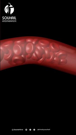 Hemorrhagic Stroke: Understanding the Causes and Risk Factors