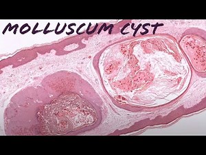 Molluscum "Cyst" (cystic molluscum contagiosum) pathology dermpath dermatology dermatopathology