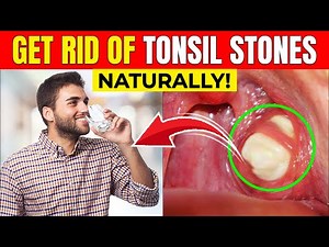 Tonsil Stones: The Hidden Cause of Bad Breath (And How to Remove Them FAST)