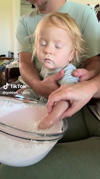 Hand mold before surgery: making a keepsake for thumb hypoplasia