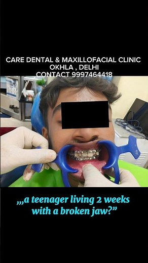 Jaw Fracture Fixed with IMF | Clinical Case |🗯️Inter Maxillary Fixation ✅ #oralsurgery #facesurgery