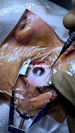 Blur to Clarity in Seconds | PRK Eye Surgery Journey - Hyderabad #envisionlasikcentre