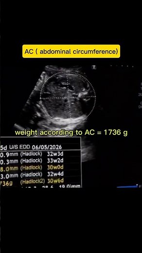 AC | abdominal circumference taking method on ultrasound #ultrasound #radiology. #pregnancyscan