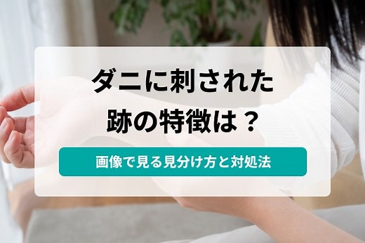ダニに刺された跡の見分け方｜虫刺されとの違いと治し方・受診目安｜すまいのホットライン