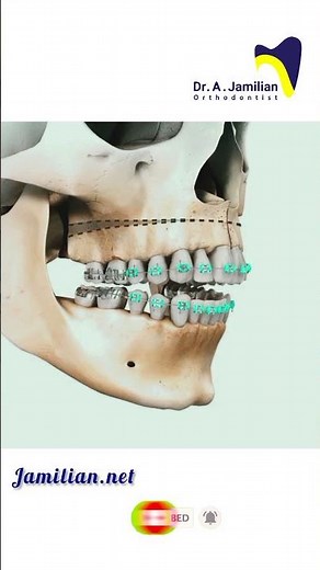 How to treat open bite in adult patients #dentist #dentistry #open_bite #orthodontics