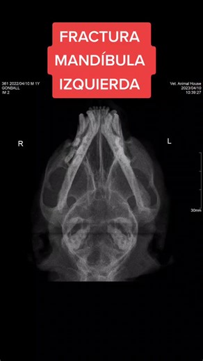 Luxo-fractura a nivel del proceso condilar de la mandíbula del lado izquierdo. ❖ Fractura a nivel de la rama mandibular izquierda. ❖ Incremento de radio densidad a nivel de hueso maxilar del lado izquierdo y en tejido blando circundante. ❖ Leve incremento de la radio densidad en cavidad nasal. ➢ Imagen radiográfica tomada en posición ventro dorsal y latero lateral. #minino #veterinarylife #castraciongatos #veterinaryhospital #veterinarian #veterinarios #fracturas#mandibula #catsoftiktok #catlove