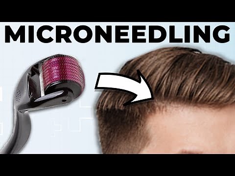 Microneedling For Hair Loss – New Insights! (Our Study)
