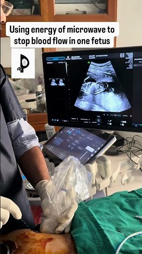 Microwave ablation for TTTS—selective reduction to protect the healthier twin in MCDA pregnancy