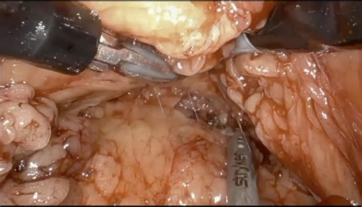 A urologist shares his experience with retroperitoneal single-port robotic surgery | Urology Times