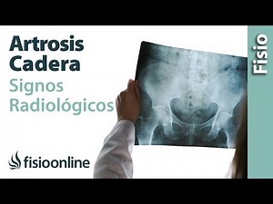 Artrosis de cadera - Signos radiológicos