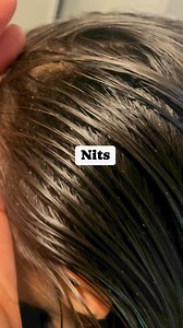 31K views · 46 reactions | What nits look like on hair l lice eggs l lice removal service #explore #hair #momlife #piojos #lice | Stacey The Louse Lady | Facebook