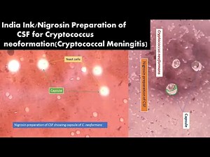 Capsules of Cryptococcus neoformans in India Ink or Nigrosin Preparation of CSF