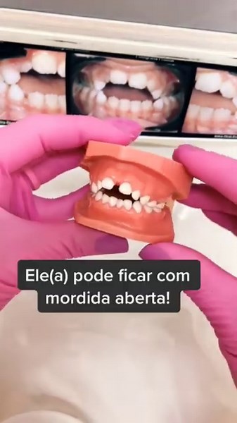 🦷 Dentes de Criança Que Usa Chupeta 🦷