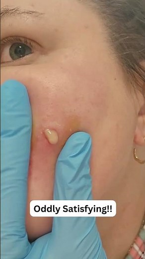 Large Blackheads Extraction Big Cystic Acne Blackheads&Whiteheads Removal Pimple Popping #1026 2026
