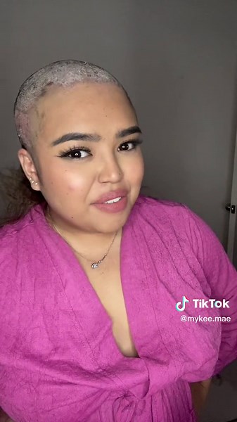 Feels and looks so much better now after treatment 🤍 | scalp psoriasis treatment