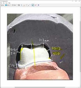 Crown Preparation Tips for ADEX Exam Success | Key Feedback & Adjustments