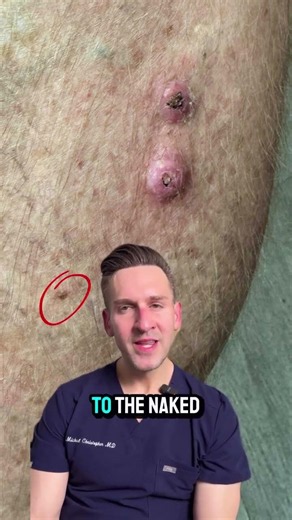 When you look at this leg, you see the two obvious skin cancers