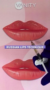 Lip Filler Techniques: Linear vs. Russian Approach