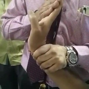 L'astérixis (ou « flapping tremor » ou « myoclonie négative ») est un signe clinique observé en neurologie et caractérisé par la chute brutale et de brève durée du tonus des muscles extenseurs de la main. Ceci produit un mouvement rythmique comparable à un battement d'ailes lors du maintien des attitudes. Il survient dans diverses encéphalopathies métaboliques, notamment l'encéphalopathie hépatique ou encore en cas d'encéphalopathie hypercapnique. 🖐🖐 | Tout savoir sur la Médecine