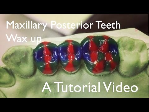 Maxillary posterior teeth - Wax up