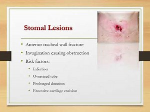 TRACHEOSTOMY: COMPLICATIONS AND ITS MANAGEMENT