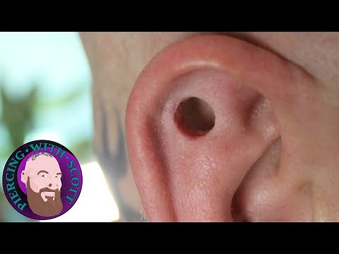 Storytime: My First Biopsy Punch