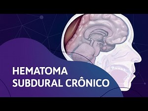 Hematoma Subdural Crônico - Coágulos na cabeça