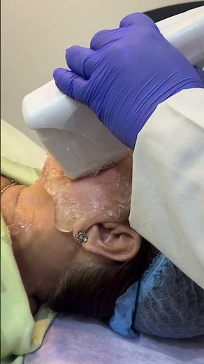 HIFU Face Lifting Results 😍 Non-Surgical Skin Tightening | Before & After #shorts