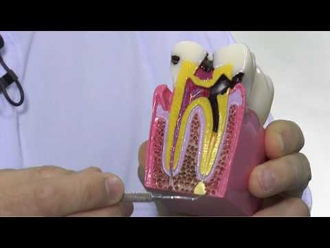 Tipos de caries y tratamiento
