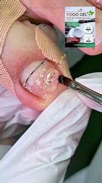 Nail prosthetics after onycholysis treatment