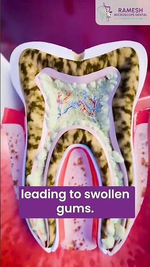 How Germs Enter Your Tooth and Cause Infection? | The Real Reason Tooth Infections Start #dentalcare