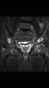 AVN Hip with OA & Hidden GT Fracture #msk #Radiology #MRI #hip#trauma#old#fracture#AVN#GT#fall