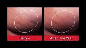 The Doctor Explains  What Cellfina Is and How It Works to Improve Cellulite of the Buttocks and Thighs