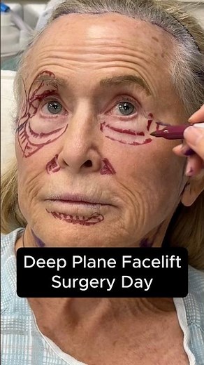 Deep Plane Facelift - Surgery Day #facelift