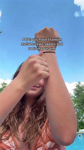 Managing Recovery After a Compound Fracture