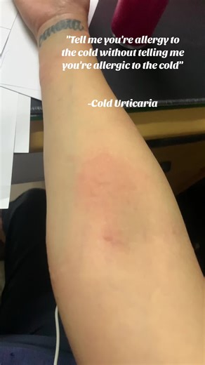 Understanding Cold Urticaria: Symptoms, Causes, and Treatment