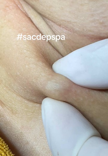 Nhẹ nhàng tình cảm #sacdepspa #thuytruong #trimungovap #pimple #nanmunbangtay