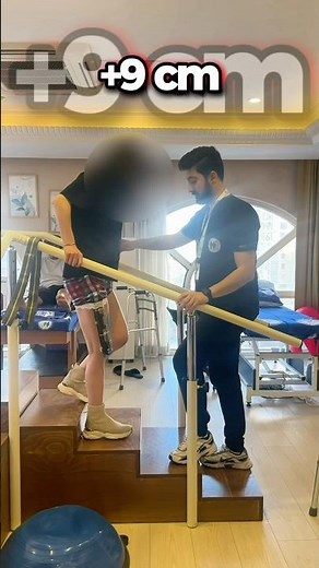 9 cm Height Increase with LON Method | Walking During Treatment & After Fixator Removal