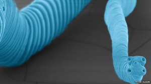 How did man die of cancer from a parasitic worm?