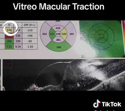 #VMT #vitreomaculartraction #opticalcoherencetomography #sharjeeleye