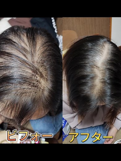女性用育毛剤の効果を検証！育毛剤で薄毛改善方法を紹介