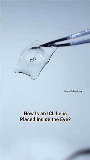 How Is an ICL Lens Placed Inside the Eye?