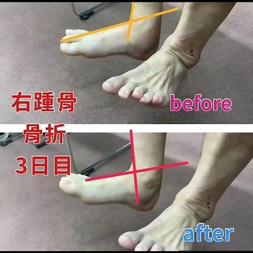 🦶踵の骨折🩼のリハビリ