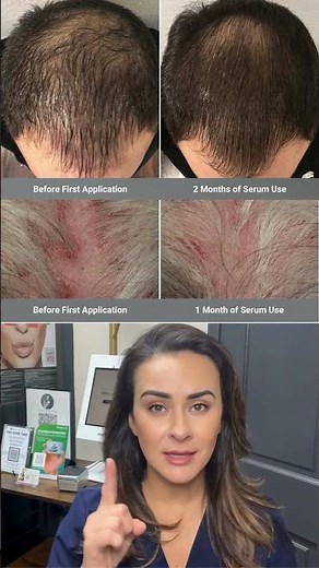 How to Wake Up Dormant Hair Follicles 💇‍♂️💎 #hairgrowth