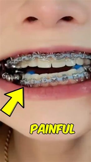 What Braces REALLY Do to Your Teeth (It’s Not What You Think!)