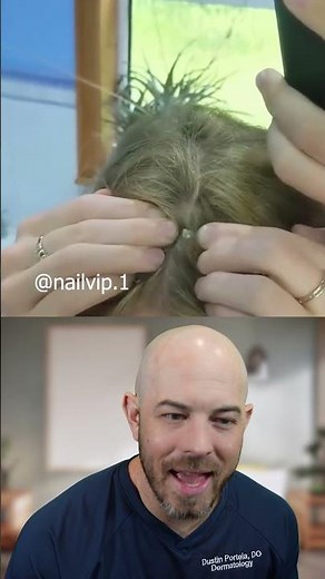 Pilar Cyst Removal: What Is a Pimple on the Head?